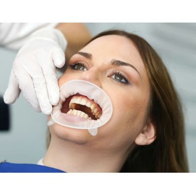OptraGate 2 Ivoclar