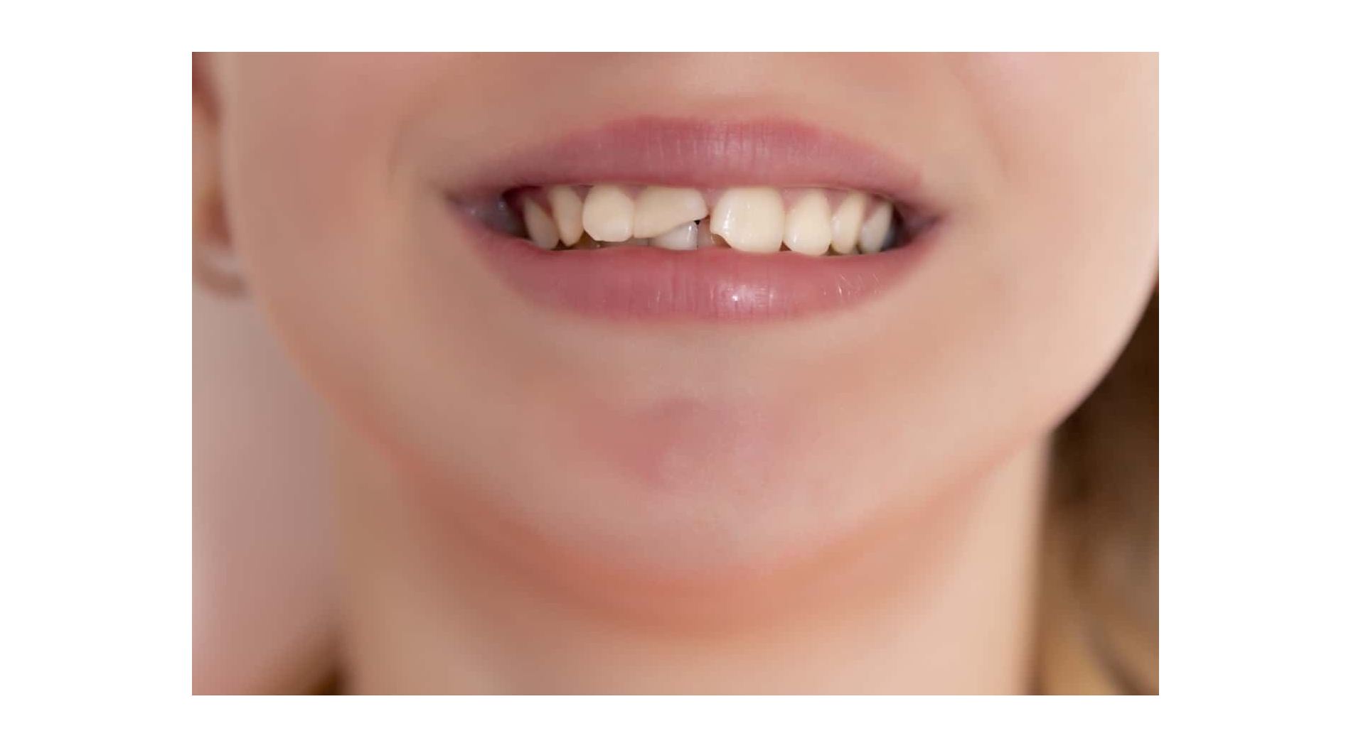 Zastosowanie kompozytów światłoutwardzalnych w stomatologii estetycznej 