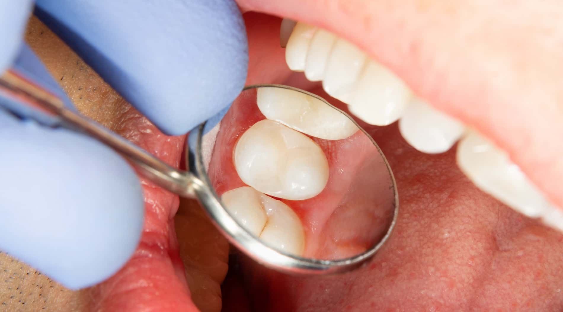 Zastosowanie G-aenial injectable w praktyce dentystycznej